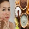 Natural Face Treatments for Women with Acne-Prone Skin