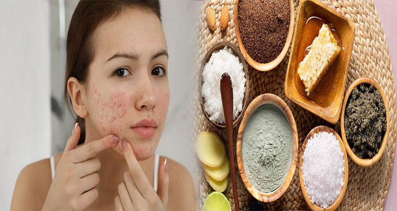 Natural Face Treatments for Women with Acne-Prone Skin